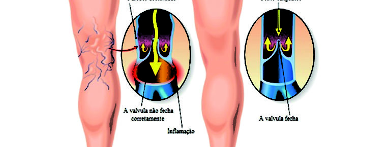 tratamento_de_varizes